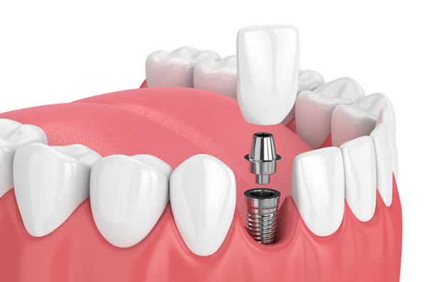 dental implants in burlington